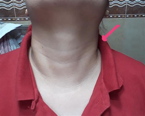 Few weeks ago I noticed my left side neck is swollen I don't know if this is a muscle knot or ...