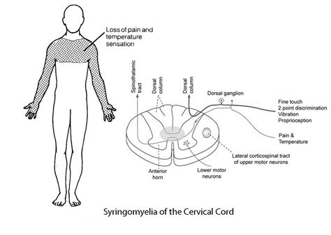 Syringomyelia