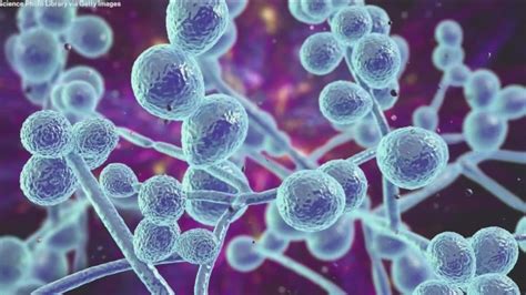 Fungal meningitis death toll among Texans on the rise | kvue.com