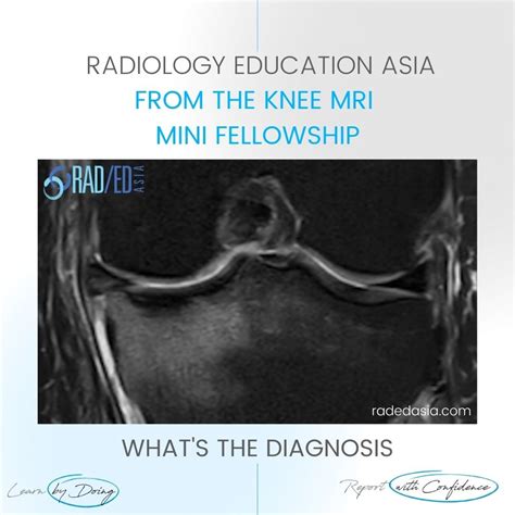 SUBCORTICAL SUBCHONDRAL FRACTURE KNEE MRI TIBIAL PLATEAU (VIDEO ...