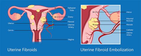 Uterine Fibroids - Preferred Fibroid and Vascular Center