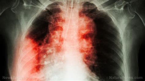 Cancer treatments HARM patients: Radiotherapy can cause aggravated lung injury – study