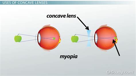 Concave Lens | Definition, Uses & Examples - Lesson | Study.com