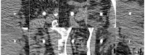 Examples of pelvic calcifications. Upper row Distal ureteral stones,... | Download Scientific ...