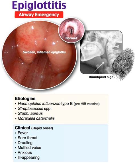 Epiglottitis | Medical surgical nursing, Pediatric medicine, Pediatrics