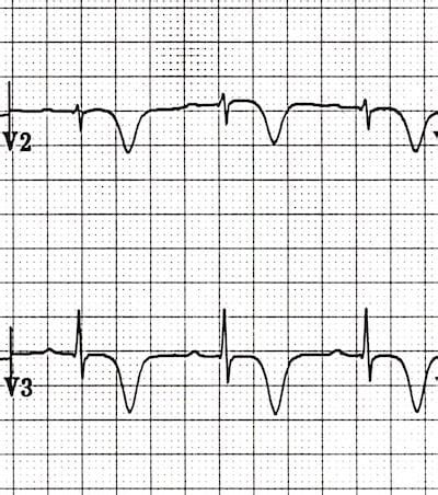 Wellens Syndrome • LITFL • ECG Library Eponym