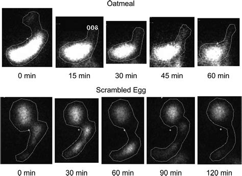 The Gastric Emptying Study: Protocol Design Considerations | Journal of Nuclear Medicine Technology