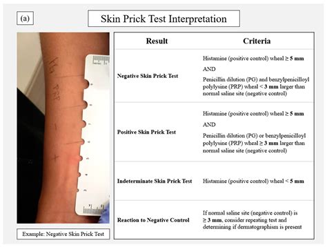 Pharmacy | Free Full-Text | Penicillin Allergy Skin Testing in the Inpatient Setting