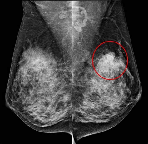 Mammogram: focal asymmetry – Radiology Cases