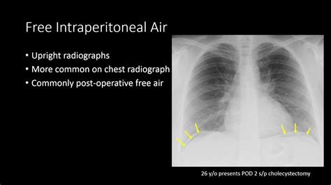 Managment of Free Intraperitoneal Air on Radiographs - YouTube