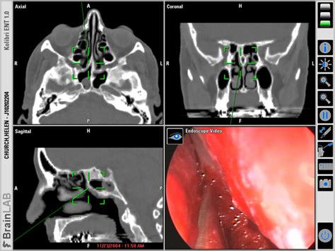 CTSCANS :: Sphenoid Sinus Mass :: Sphenoid_Sinus_Cyst_1