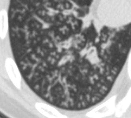 Tree-in-bud sign (lung) | Radiology Reference Article | Radiopaedia.org