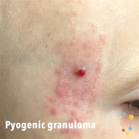 Pyogenic granuloma - Skin Deep