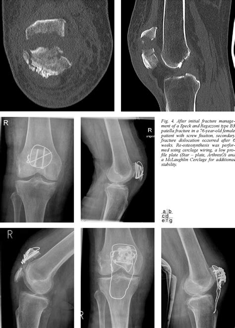 [PDF] Patellar fractures--a review of classification, genesis and evaluation of treatment ...