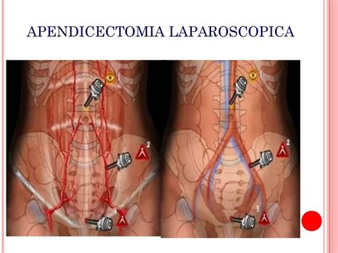 Apendicectomia laparoscopica