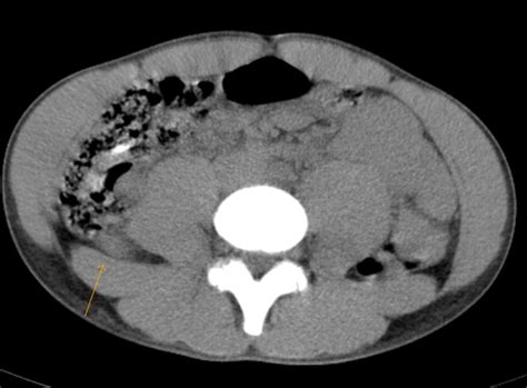 Appendicitis-CT - Sumer's Radiology Blog