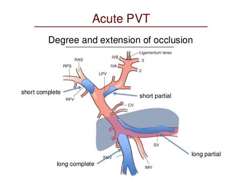 Portal vein thrombosis: scenarios and principles of treatment