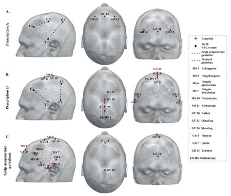 JCM | Free Full-Text | Neuroimaging-Based Scalp Acupuncture Locations for Dementia