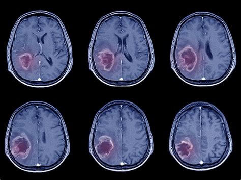 Premium Photo | Ct-scan brain imaging for hemorrhagic stroke or ...