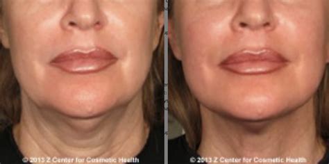 Top Jawline Treatments: Ultherapy, Thermitight, Sculptra, Kybella | Z ...