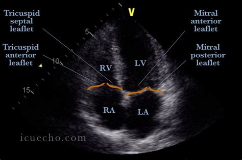 Apical 4 Chamber - ICU & Echo in 2021 | Cardiac sonography, Tricuspid ...