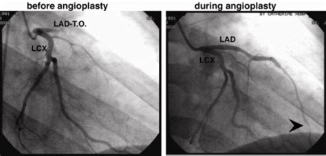 Coronary angiogram showing a total occluded left anteri | Open-i