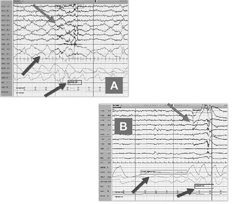 A)N1 arousal (Grey arrow) preceded by Roving eye movements and ...