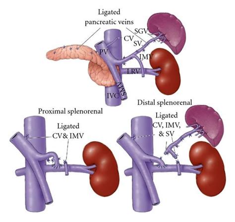 DISTAL SPLENORENAL SHUNT PDF