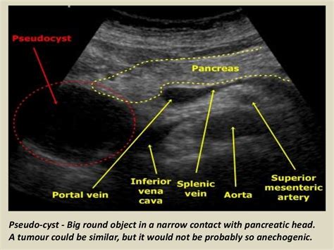 Ultrasound of pancrease in Radiology