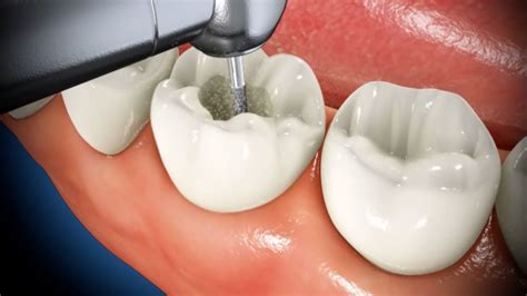How an Endodontist Can Save You With Tooth-saving Root Canal Procedure | West Cobb Dentistry