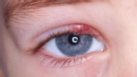 What Is An Eye Stye? Causes, symptoms, and Treatment