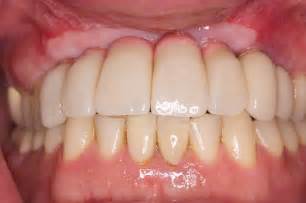 Full Mouth Reconstruction - Austin, TX - Full Mouth Restoration