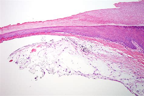 Digital Mucous Cyst | Dermatopathology