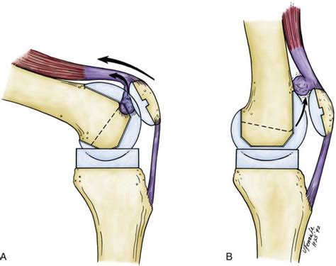 Complications of Total Knee Arthroplasty | Musculoskeletal Key