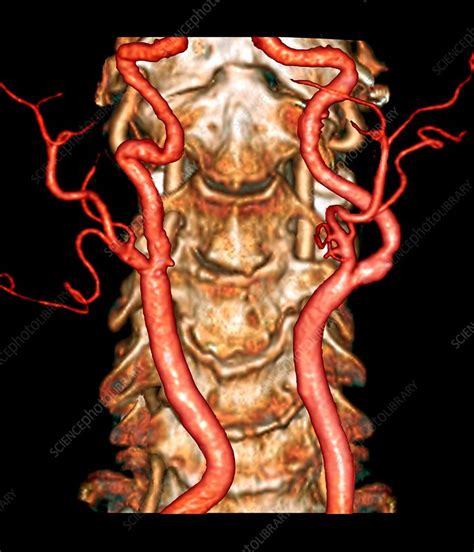 Carotid artery disease, 3D CT angiogram - Stock Image C033/7382 - Science Photo Library