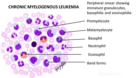 Peripheral smear findings in Leukemia - Illustrated - Pathology Made Simple