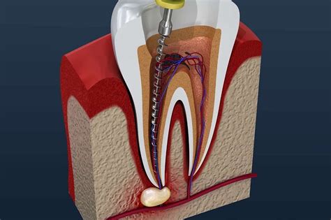 How Long Does a Root Canal Procedure Take?