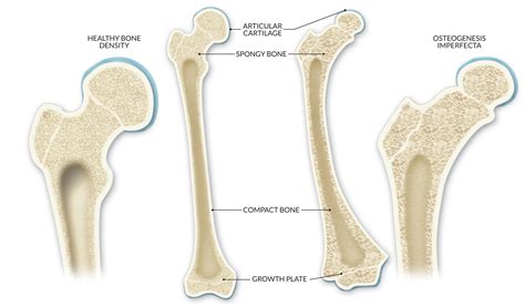 Osteogenesis Imperfecta (OI) | Limbhealing.com