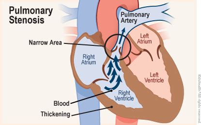 Pulmonary Stenosis | Rady Children's Hospital