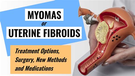 Uterine Fibroids: Treatment Options, Surgery, New Methods | SurgMedia