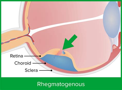 Retinal Detachment | Concise Medical Knowledge