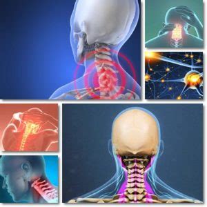 Neck Osteoarthritis: Causes, Symptoms and Treatment - NatureWord