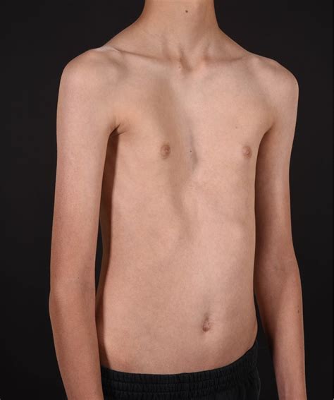 Typical pectus excavatum | British Association of Paediatric Surgeons