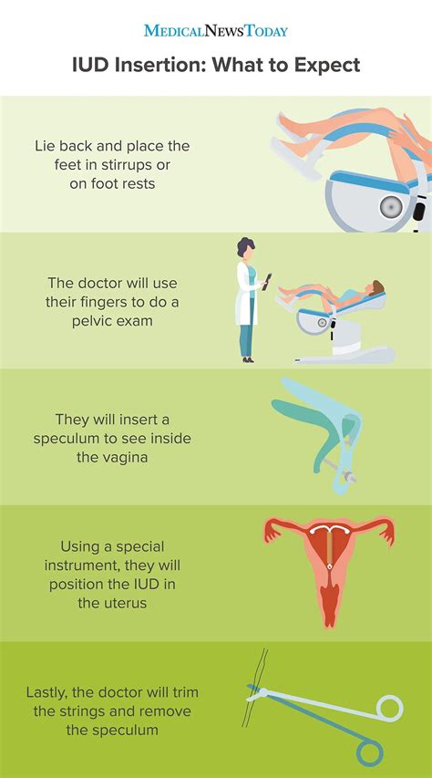 Mirena iud hormones - elementslopte