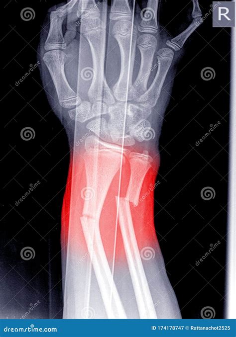 X Ray Of Human Hand With Broken Wrist Fracture Of Radius