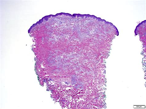 Xanthoma Eye Tendinous Tuberous And Disseminatum Causes