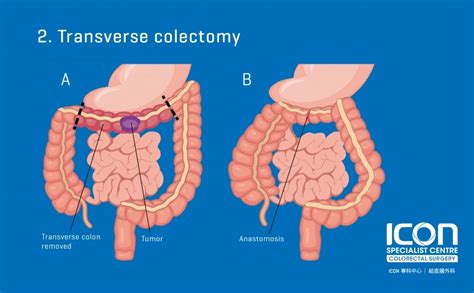 Colorectal resection (colectomy) — Icon Specialist Centre