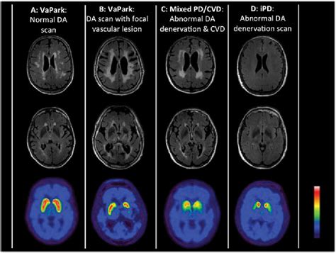 Figure 1 from An updated diagnostic approach to subtype definition of vascular parkinsonism ...