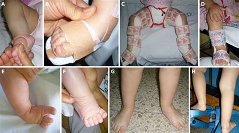 Functional physiotherapy method results for the treatment of idiopathic clubfoot