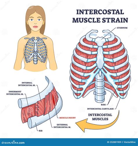 External Intercostal Muscle